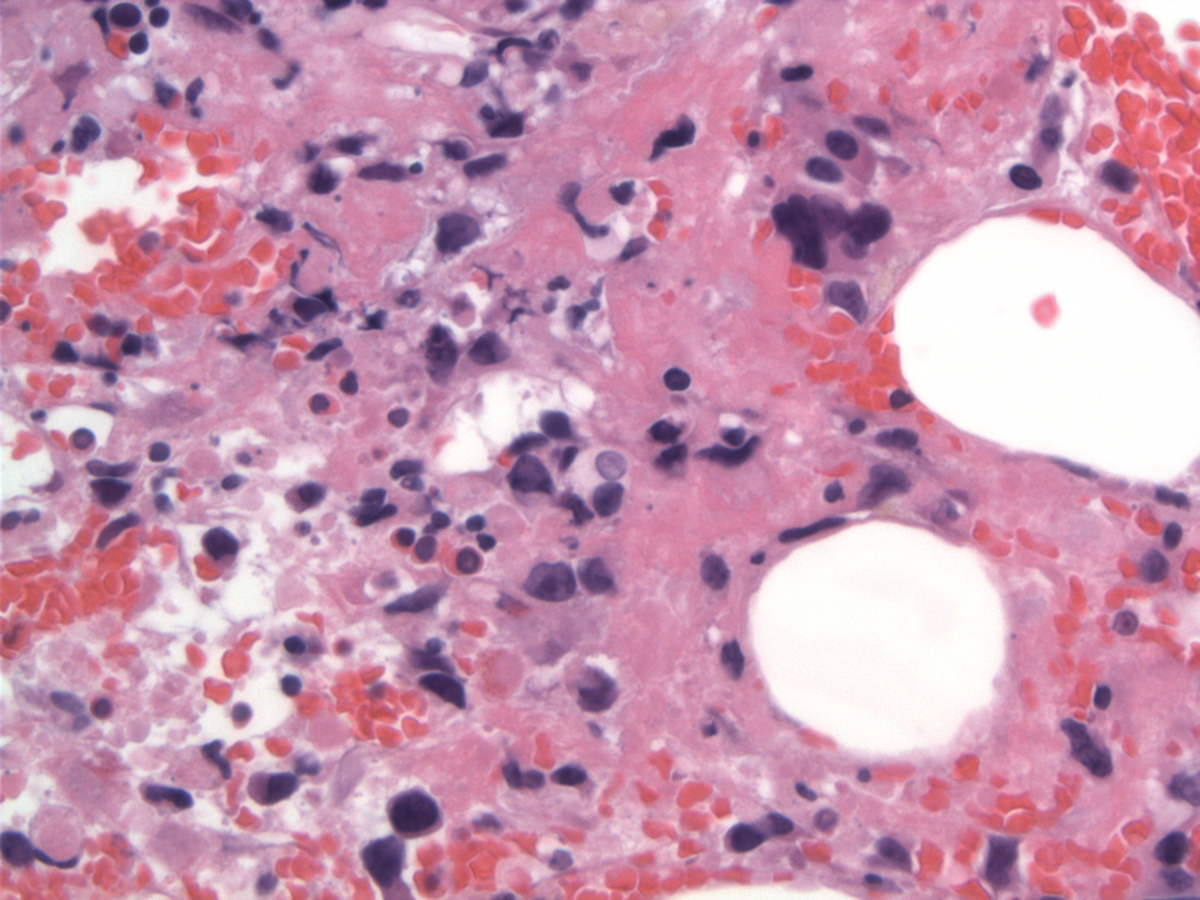 Scattered lymphoma cells with cellular debris